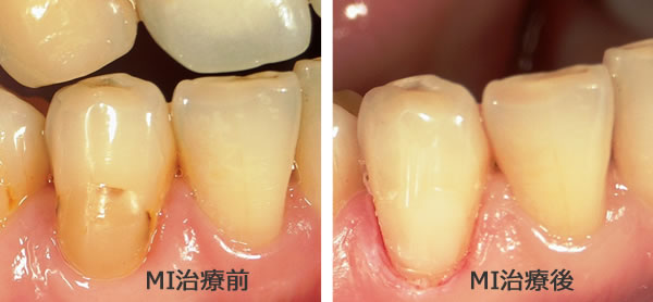 1日で治るむし歯治療（MI治療） - 東京都港区浜松町の歯科 歯医者-山口